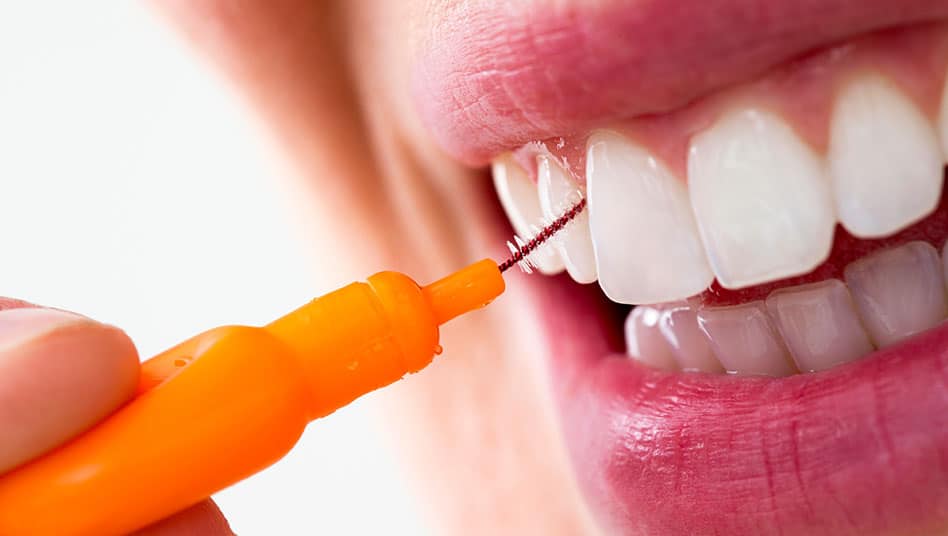 Gepflegte Zähne Karies Parodontitis Zahnreinigung