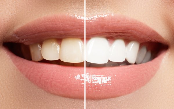 Bleaching: Zähne bleichen und aufhellen. Auch Zahnbleaching und Zahnaufhellung genannt.